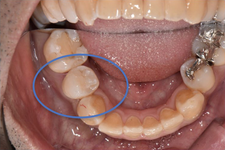 ３０代男性 奥歯の銀歯をダイレクトボンディングで再治療した症例 | の